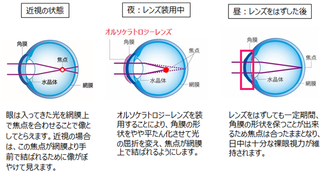 オルソケラトロジーレンズは・・・・