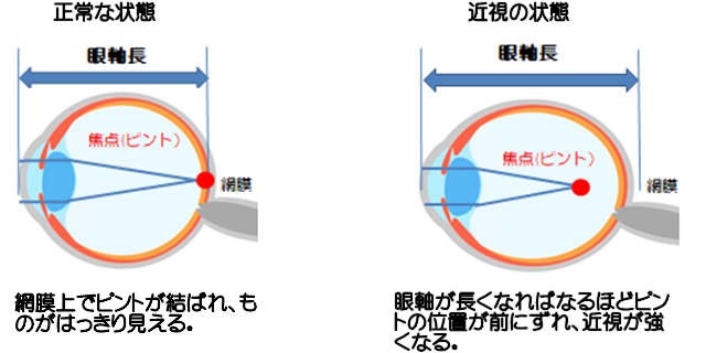 オルソケラトロジーと近視抑制効果