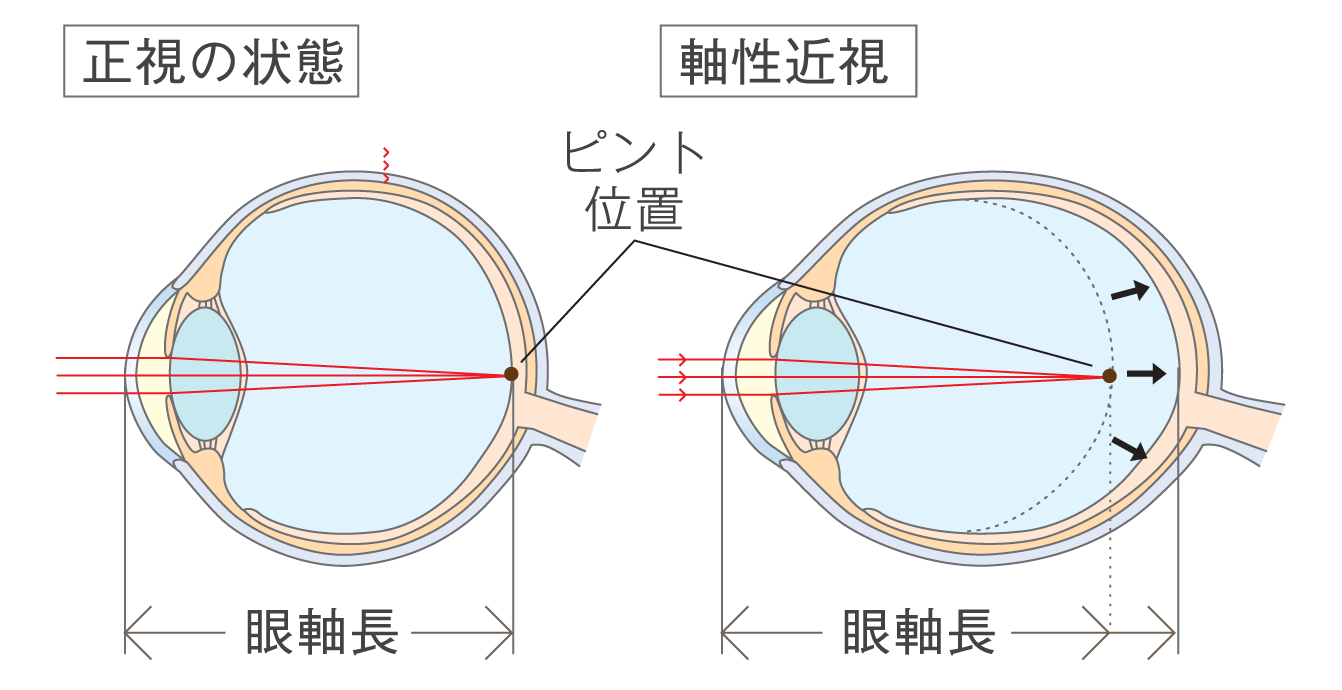 オルソケラトロジーレンズは・・・・